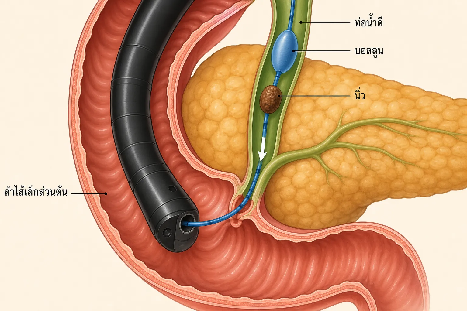 ภาพขยายการทำ ERCP โดยปลายกล้องอยู่ในลำไส้เล็กส่วนต้นส่วนที่สองตรงข้ามรูเปิดท่อน้ำดีด้านใน และสายบอลลูนผ่านแอมพูลลาเข้าไปพองเหนือก้อนนิ่วในท่อน้ำดี